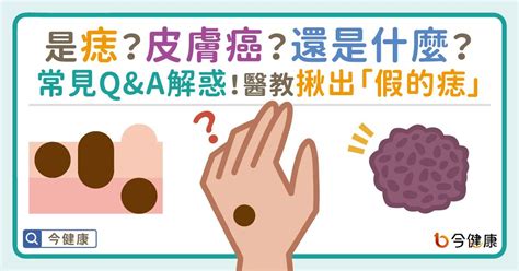 凸起來的痣|是痣or皮膚癌？醫「1張圖秒對照」 長這2部位最危險